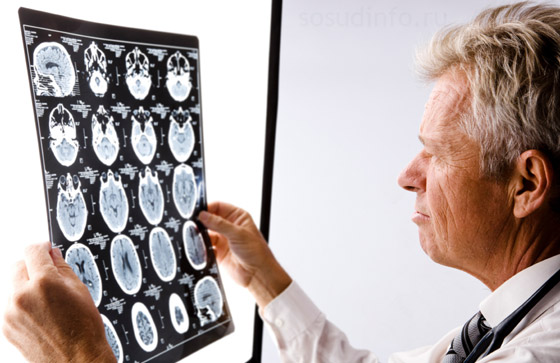 У разі виникнення підозри на атеросклероз, слід звернутися не тільки до невролога, але також пройти   УЗД внутрішньочерепних судин   ,   комп'ютерну томографію мозку   , А також здати кров на визначення рівня холестерину і його фракцій (ліпідний спектр)