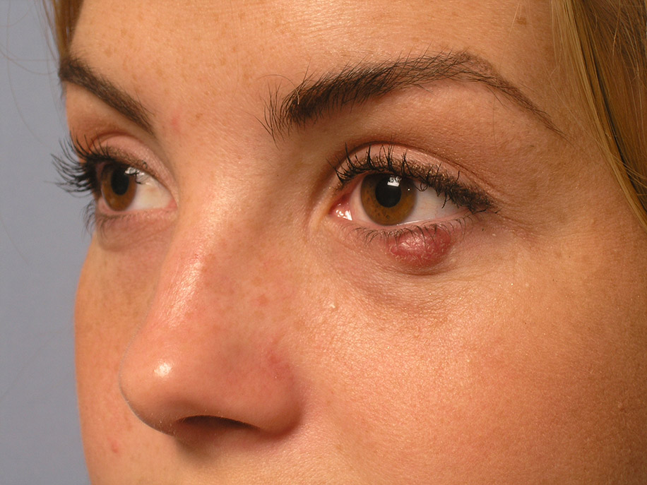 Халязіон в цьому випадку не завдає болю, але при відсутності лікування він збільшується і дратує повіки і очі