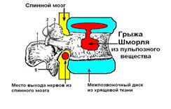 Грижа Шморля - це міграція пульпозного ядра в тіло хребця (в кістку)