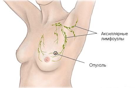Одним з основних місць метастазування раку грудей є аксилярні лімфовузли, розташовані в пахвовій області