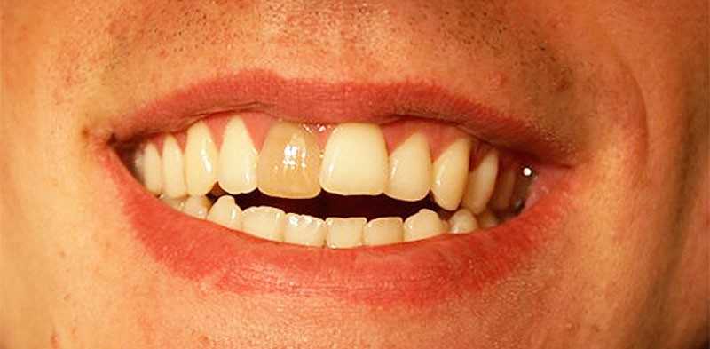 Якщо нерв видалити, з часом зуб стане більш крихким, зруйнується і потемніє навіть при правильному догляді і регулярному чищенні
