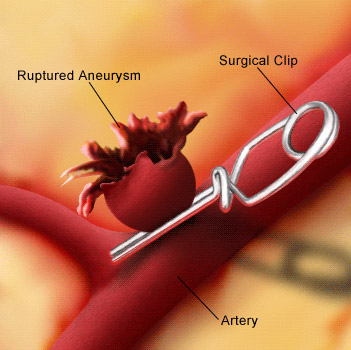 Для хірургічного видалення аневризми використовується як відкриті втручання на головному мозку: кліпування аневризми;  зміцнення стінок аневризми за допомогою укутування аневризми хірургічної марлею;  припинення кровотоку по артерії за допомогою накладання кліпс на артерію до аневризми або до і після аневризми (треппинг), так і ендоваскулярні методики