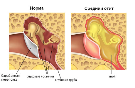 Патогенні цвілеві гриби впливають на появу отиту середнього вуха