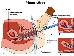 Vacuum - порожнеча і aspiratio - вдихання), в побуті іноді звана міні-аборт, - це метод штучного переривання небажаної вагітності шляхом вилучення (відсмоктування) плода за допомогою спеціального вакуумного відсмоктування