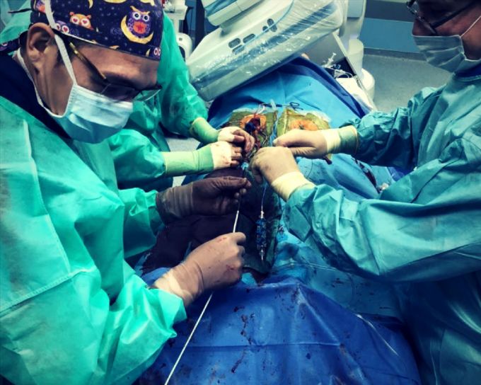 Транскатетерна трансплантація, нехай і звучить по-медичному складно, але лише означає, що для установки штучного клапана ми застосуємо катетер - довгу трубку діаметром в 4 міліметри, яка допоможе нам по судинах проникнути в аорту і опинитися на кордоні між лівим шлуночком і коренем аорти - там розташовується аортальний клапан