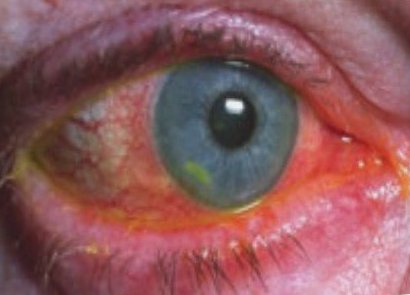 Запалення очі - найпоширеніша очна проблема