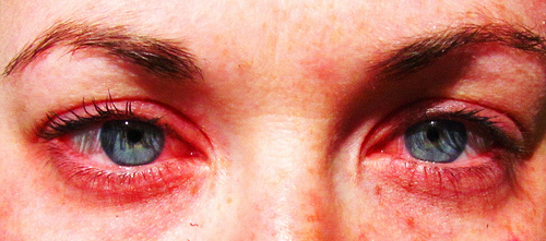 Почервоніння очей при алергії супроводжується ще деякими симптомами, які допоможуть поставити точний діагноз і призначити коректне лікування