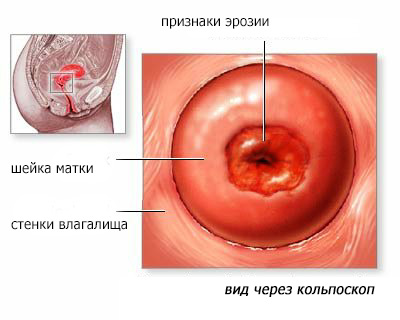 Внаслідок постійного хронічного запалення слизової шийки матки і наявність ерозії під час вагітності може бути потрапляння інфекції в матку і далі до малюка