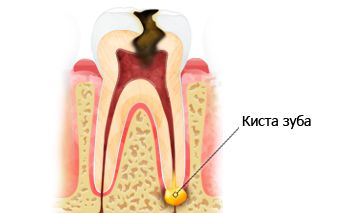 Залишена без лікування, кіста зуба росте, поступово заміщуючи тканини кістки