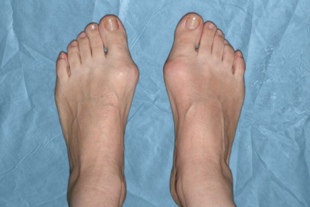 Деформація кісточки великого пальця на нозі має медична назва вальгусна деформація першого пальця стопи