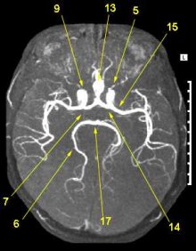 МРТ ангіографія судин головного мозку в аксіальній проекції * 5 - Очна артерія (a