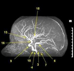 МР ангіографія артерій головного мозку в сагітальній проекції * 3 - Верхня мозочкова артерія (a