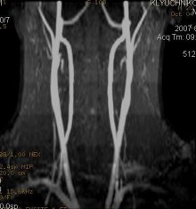 МРТ ангіографія - судини шиї в нормі