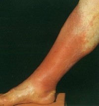 Бешиха (рожа) - це серйозне інфекційне захворювання глибоких шарів шкіри, викликане стрептококом
