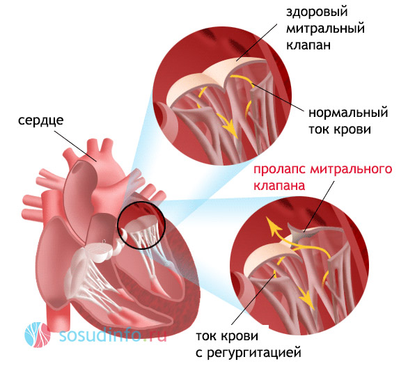 При нормальної серцевої діяльності в момент виникнення систоли передсердя повністю звільняються від крові, і мітральний клапан закриває вхід в передсердя, зворотного відтоку крові не відбувається