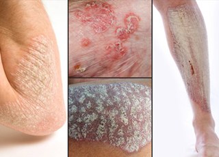 псоріаз   - це запальне захворювання шкіри, яке характеризується появою на шкірі чітко-окреслених рожевих ділянок з посиленим лущенням