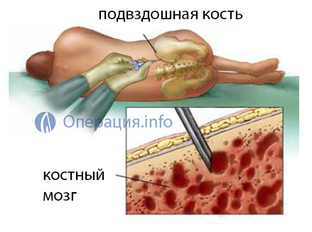 Пункцію при трепанобиопсии виробляють в області гребеня клубової кістки, відступивши назад від її передньої верхньої ості на кілька сантиметрів