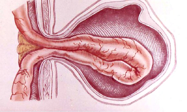 Здійснення виходження внутрішніх органів через природні і патологічні отвори, розташовані на поверхні живота, під шкірну поверхню носить назву вентральна грижа