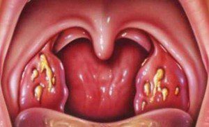 При деяких захворюваннях утворюється висип в горлі
