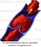 Виникає тромбоемболія (закупорка) легеневої артерії, що призводить до миттєвої смерті