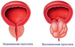 Кишкова паличка, яка у 80% випадків виступає причиною бактеріального простатиту   Як виглядає хвора збуджена простата (збільшена в розмірах)   Запалення і інфекція від простатиту може призвести до макрогематурії (кров у сечі)