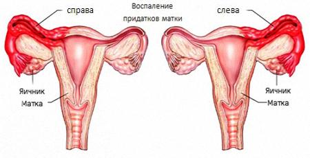 У загальній структурі хвороб в гінекологічній сфері запалення придатків матки знаходиться на чільному місці