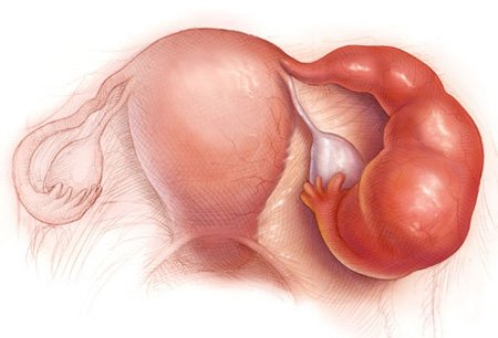 Це запалення придатків на другій стадії розвитку, внаслідок чого відбувається утворення пухлини, спайок між яєчниками, маткової трубою і прилеглими органами