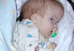 Набряк мозку у новонароджених дітей - це недуга, який стає все більш поширеним, від нього страждає все більше малюків