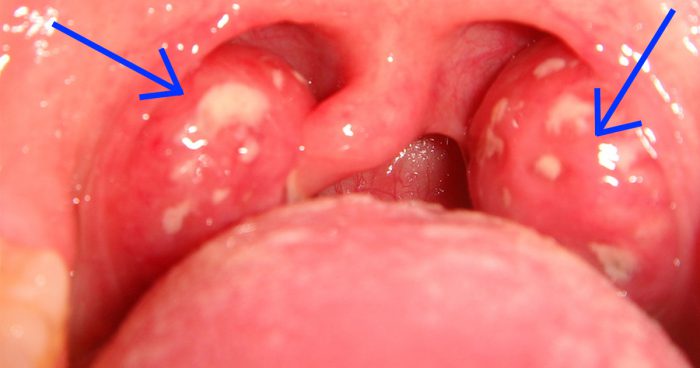 Скупчення лімфоїдної тканини в горлі в медичній практиці називають гландами