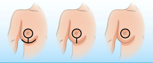 якірна мастопексия (Т-подібний розріз) передбачена в самих запущених випадках (наприклад, коли сосок дивиться в підлогу)