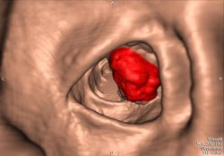 3D реконструкція товстої кишки - пухлина виділена червоним кольором