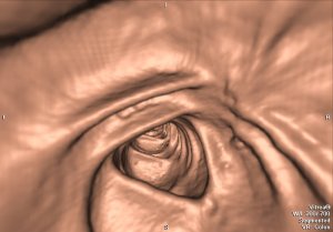 Віртуальна колоноскопія - на фото: нормальний просвіт товстої кишки