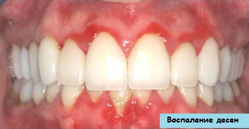 Запалення ясен знаходиться на другому місці за поширеністю після карієсу зубів, серед усіх стоматологічних захворювань