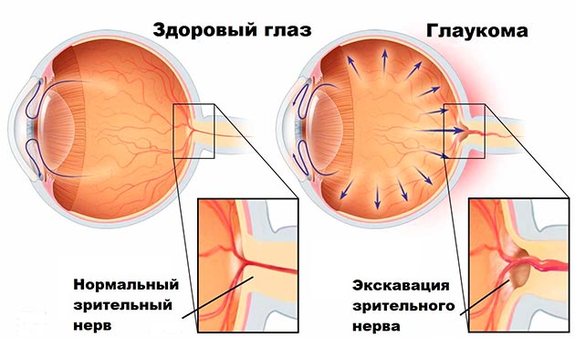 Глаукома протікає в різних формах (в залежності від викликали її причин), кожна з яких має свою симптоматику