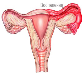 Запальні процеси, які протікають в статевих органах, як чоловіки, так і жінки, в першу чергу, викликані інфекцією