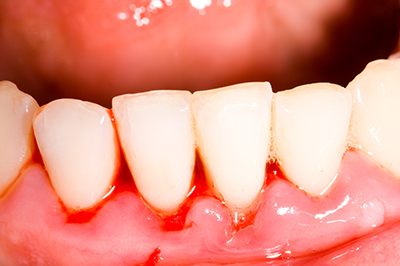 Гінгівіт - це захворювання верхнього краю ясен, прилеглих до зубах