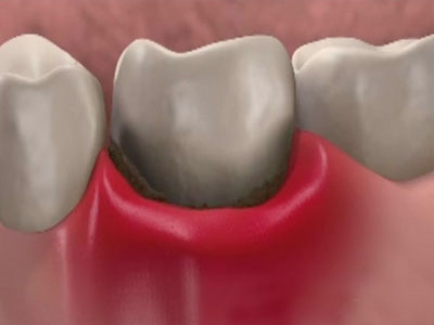 Якщо не зупинити гінгівіт і не прийняти ніяких лікувальних заходів, то запалення може проникнути вглиб ясен і поширитися на кісткові тканини зубної щелепи