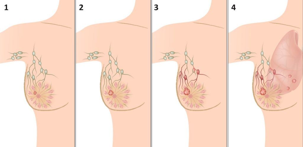 Рак грудей 1 і 2 стадії називають раком ранній стадії, або локалізованим раком