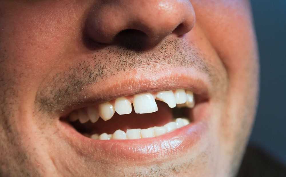 Наприклад, сильним засобом, що знімає біль, є прополіс - прикладання його до зуба допомагає забути про пульпіті, але зуб при цьому все одно руйнується
