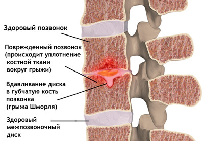 При розвитку патологічного процесу в поздовжньої проекції драглисте тіло диска зміщується в кісткову тканину хребта через гиаліновий хрящ (грижа Шморля)