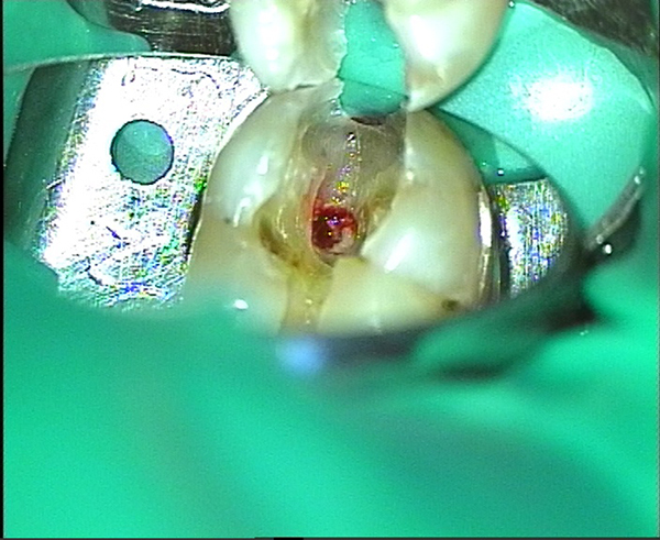 Глибока тріщина в дентині нижче рівня ясен під збільшенням операційного мікроскопа