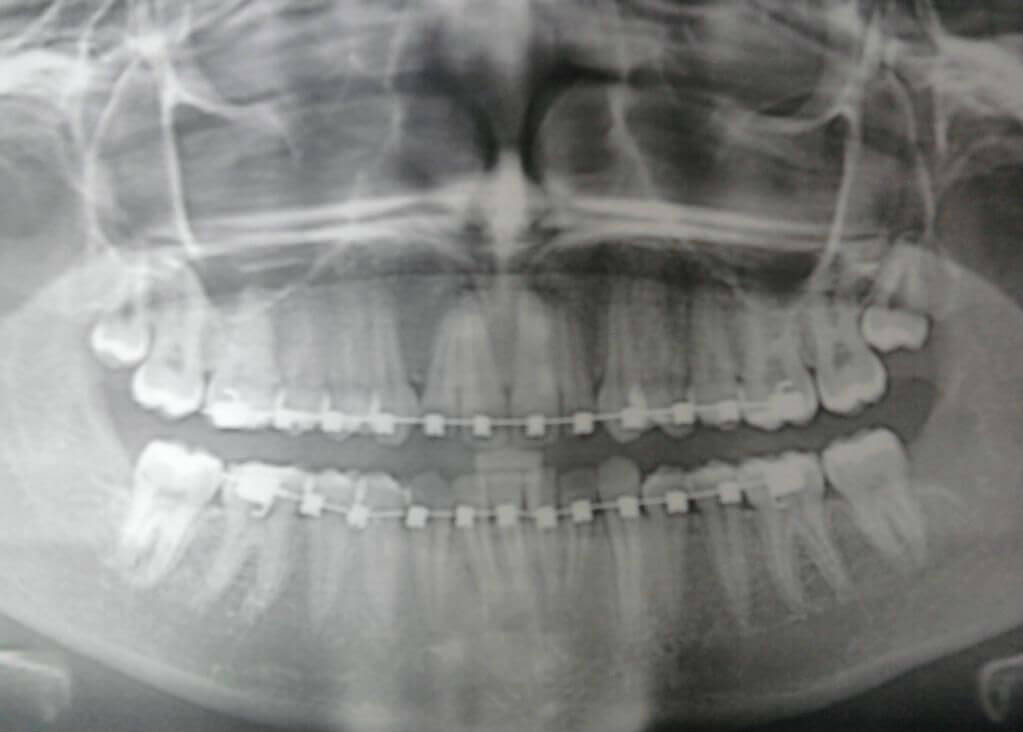 виправлення зубів   брекет-системою   - тривалий процес, який займає близько двох, а іноді і трьох років