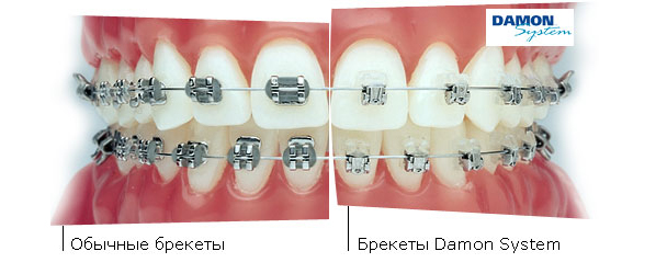 Якщо в якості результату ортодонтичного лікування ви очікуєте справжнього дива, без роздумів вибирайте брекет-системи Damon