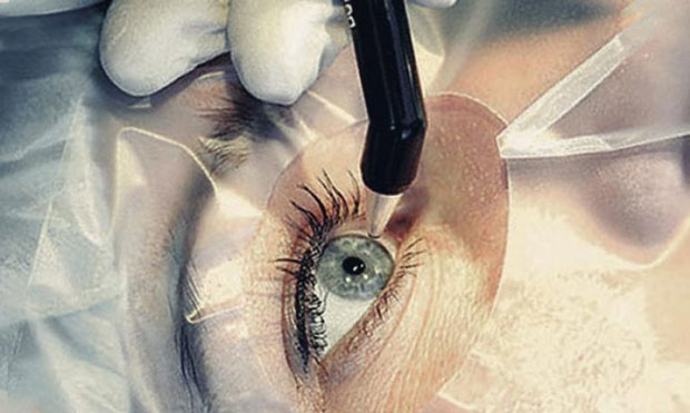 Сьогодні можна не чекати, коли зір критично погіршиться, а проводити операцію при гостроті 0,1-0,2