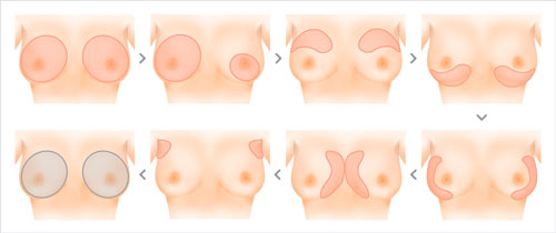 Нерідко, вдаючись до пластики грудей, жінки віддають перевагу одночасно збільшити обидві груди або   здійснити підтяжку