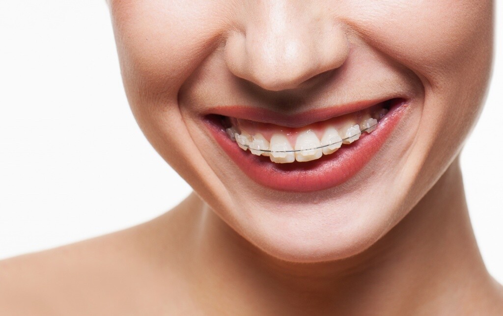 Ортодонтичне лікування з видаленням зубів