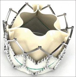 Клапан-зберігаючі операції на аорт е є такими втручаннями, при яких власний аортальний клапан пацієнта зберігається