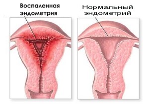 Запальний процес в матці має короткочасний характер, переходячи в придатки матки або в тазову очеревину