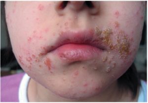 Грибкові, а також бактеріальні запалення губ і шкіри навколо них - супутній симптом при таких хворобах, як:
