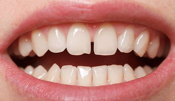при   зміні молочного прикусу   заздалегідь знати неможливо, якими стануть постійні зуби, в тому числі ніхто не застрахований від появи щілини між зубами
